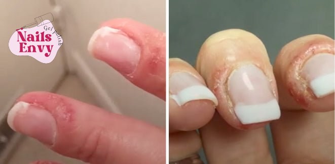 Allergic reaction to gel polish shows symptoms on fingertips