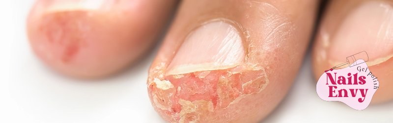 Allergic to gel nails causes and hypoallergenic solutions