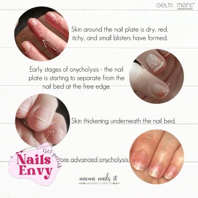 Can I be allergic to gel polish?