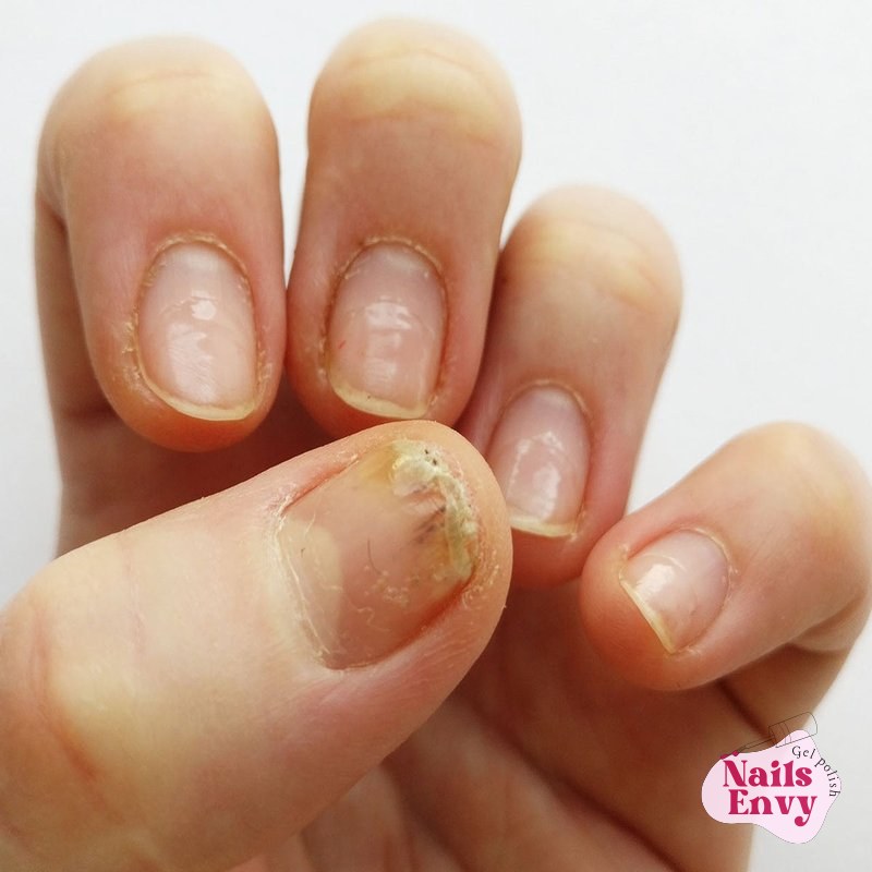 Gel nail allergy symptoms and treatment options