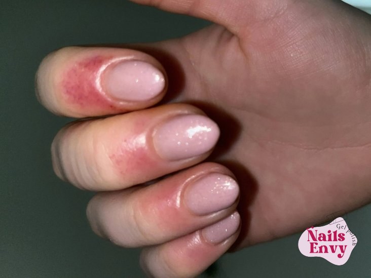 Gel polish allergy illustration