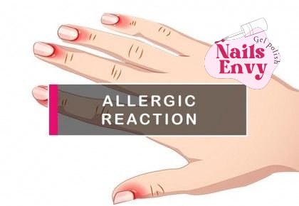 How to treat an allergic reaction to gel nail polish?