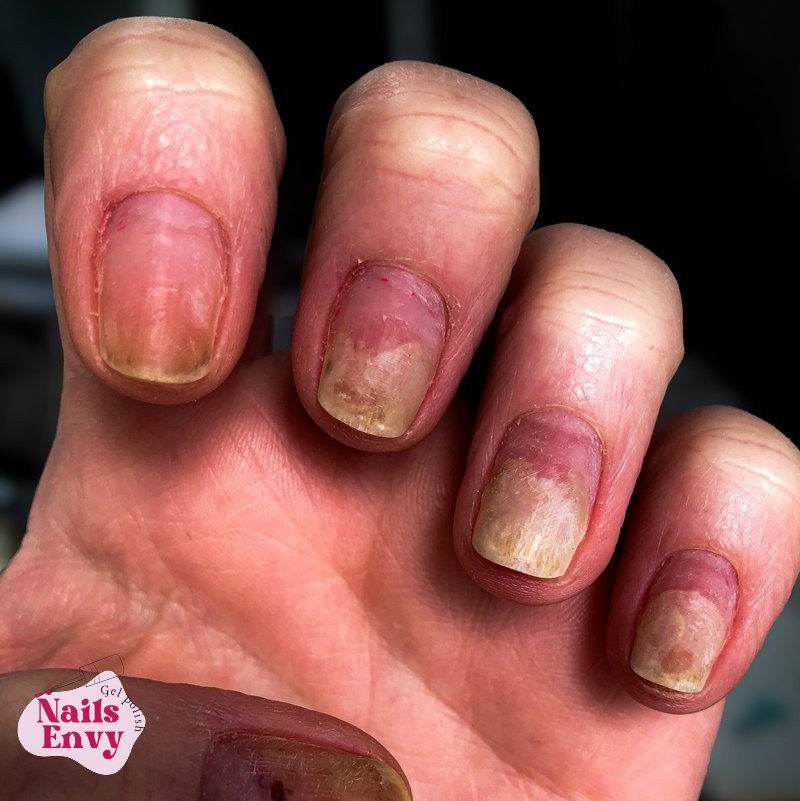 Study on gel nail polish allergic reactions